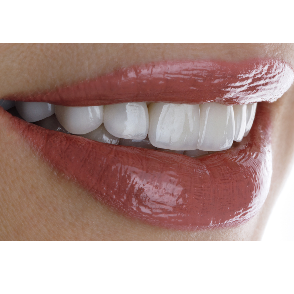 Signature Same-Day Veneers