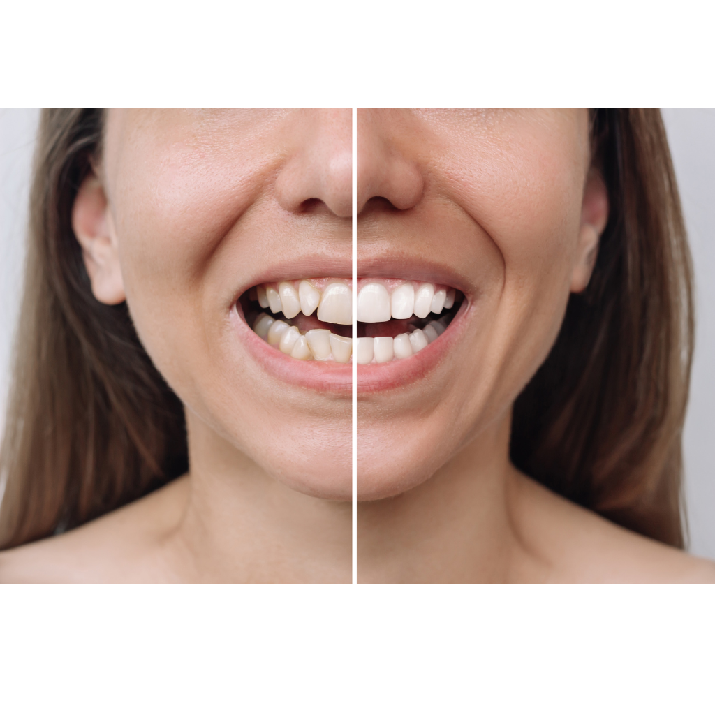 AI Smile Design Before and After